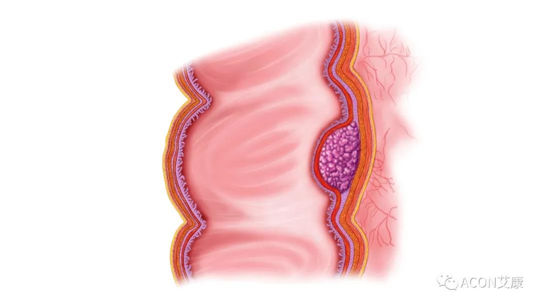 因?yàn)楹鲆暽眢w出現(xiàn)的這些變化，他們最后被確診結(jié)腸癌