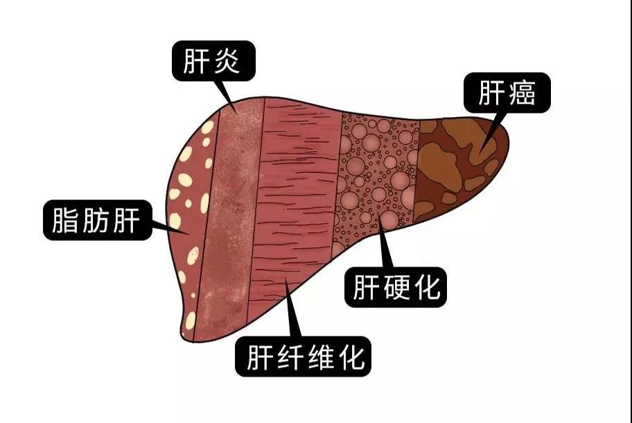 脂肪肝的最大敵人不是肥胖，答案竟是這樣！