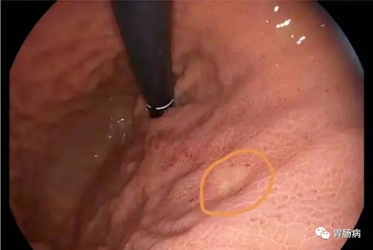 醫(yī)生總結(jié)了3位年輕胃癌患者的病例：30歲不到的他們到底干啥了？