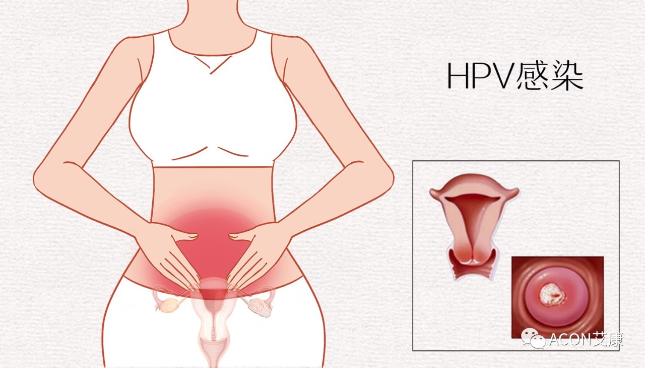 HPV轉(zhuǎn)陰其實很簡單， 女性必知的宮頸癌真相