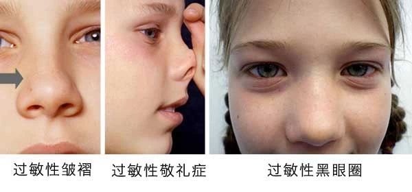 過敏性鼻炎會讓孩子變傻？！家長該如何應(yīng)對